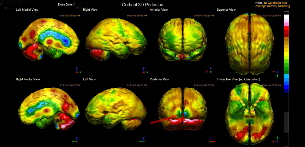170925 Water Skiing CTE Brain Scan Cortical Perfusion